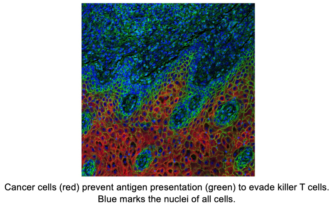 Microscopic image showing cancer cells in red avoiding immune detection by preventing green-colored antigen presentation. Blue highlights the nuclei of all cells, indicating dense tumor tissue structure.